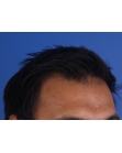 After Hair Transplant&nbsp;2 Sessions (Areas)